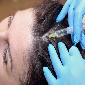 All About Hair Loss PRP